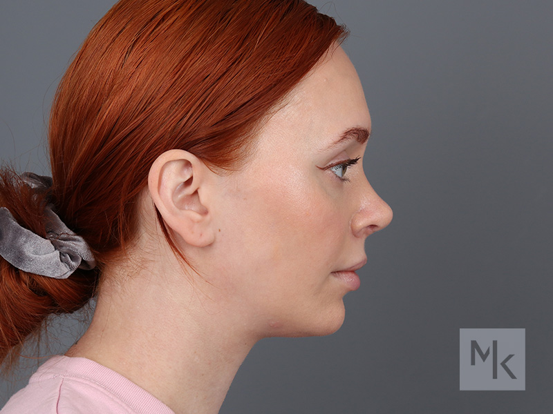 Rhinoplasty Before and After | Dr. Michael Kim