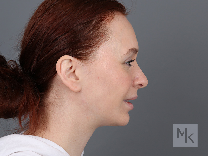 Rhinoplasty Before and After | Dr. Michael Kim