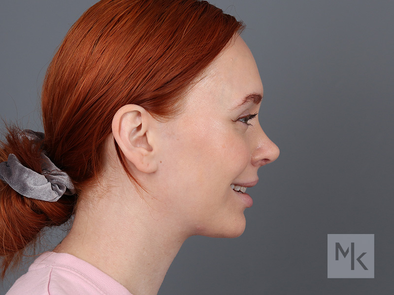 Rhinoplasty Before and After | Dr. Michael Kim