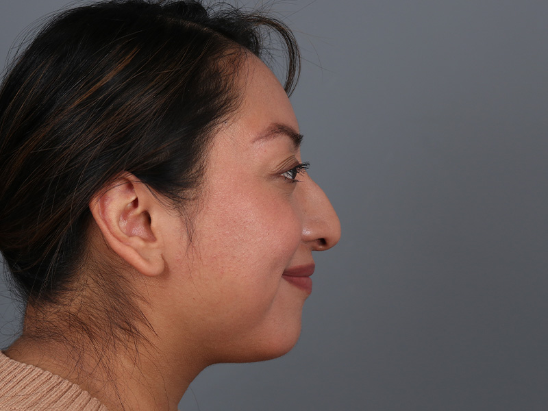Rhinoplasty Before and After | Dr. Michael Kim