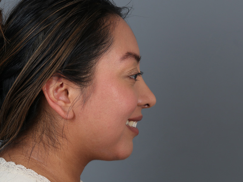 Rhinoplasty Before and After | Dr. Michael Kim