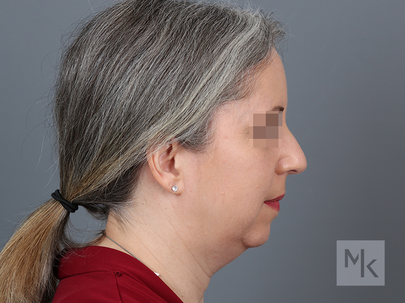 Rhinoplasty Before and After | Dr. Michael Kim