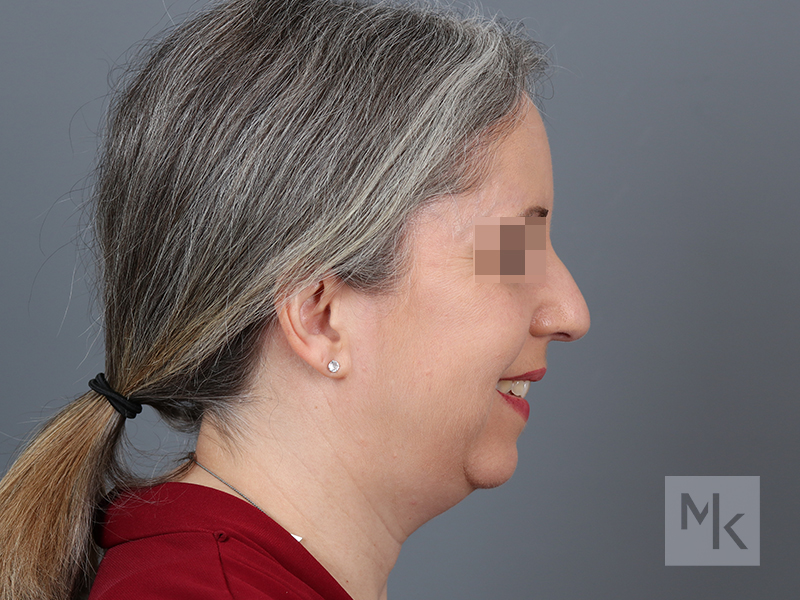 Rhinoplasty Before and After | Dr. Michael Kim