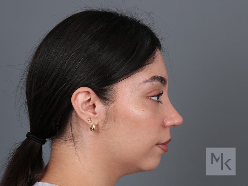 Rhinoplasty Before and After | Dr. Michael Kim