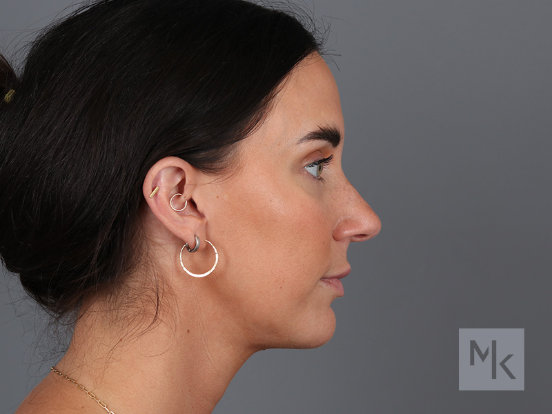 Rhinoplasty Before and After | Dr. Michael Kim