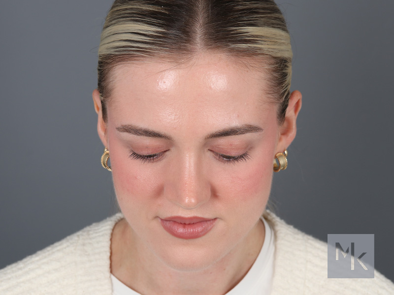 Rhinoplasty Before and After | Dr. Michael Kim