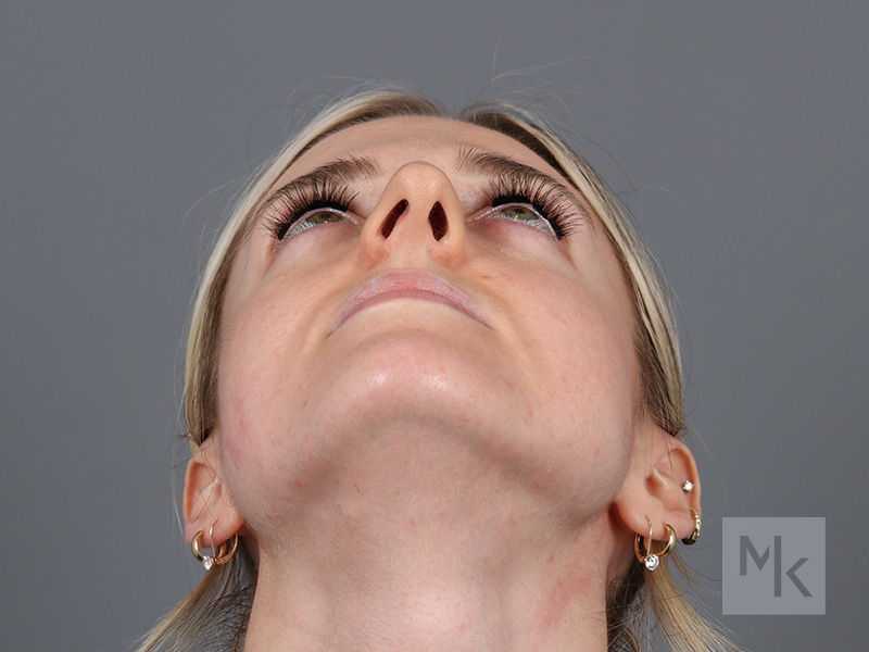Rhinoplasty Before and After | Dr. Michael Kim