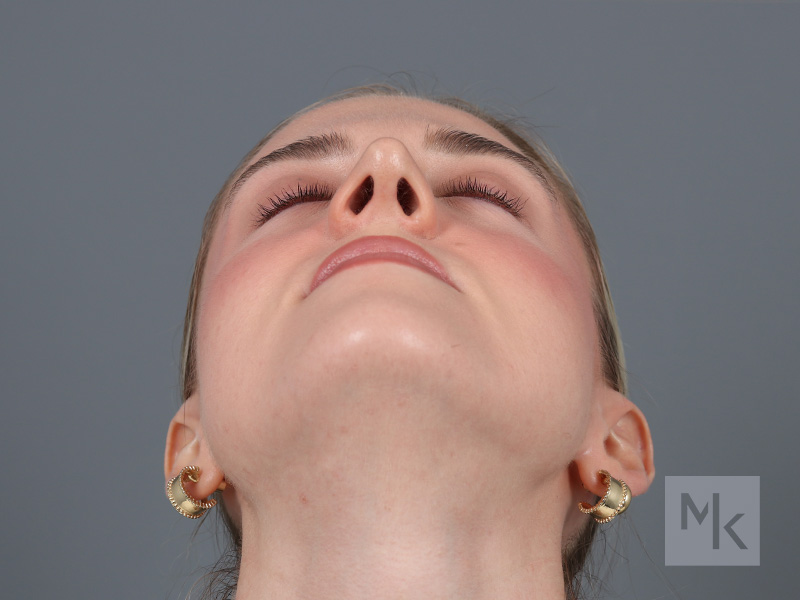 Rhinoplasty Before and After | Dr. Michael Kim