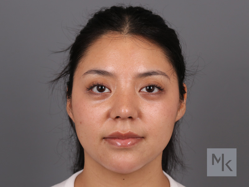 Rhinoplasty Before and After | Dr. Michael Kim