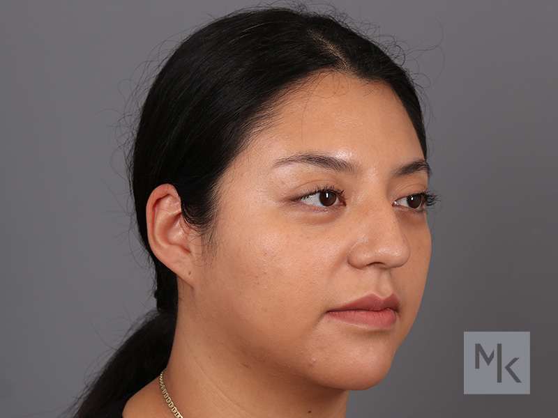 Rhinoplasty Before and After | Dr. Michael Kim