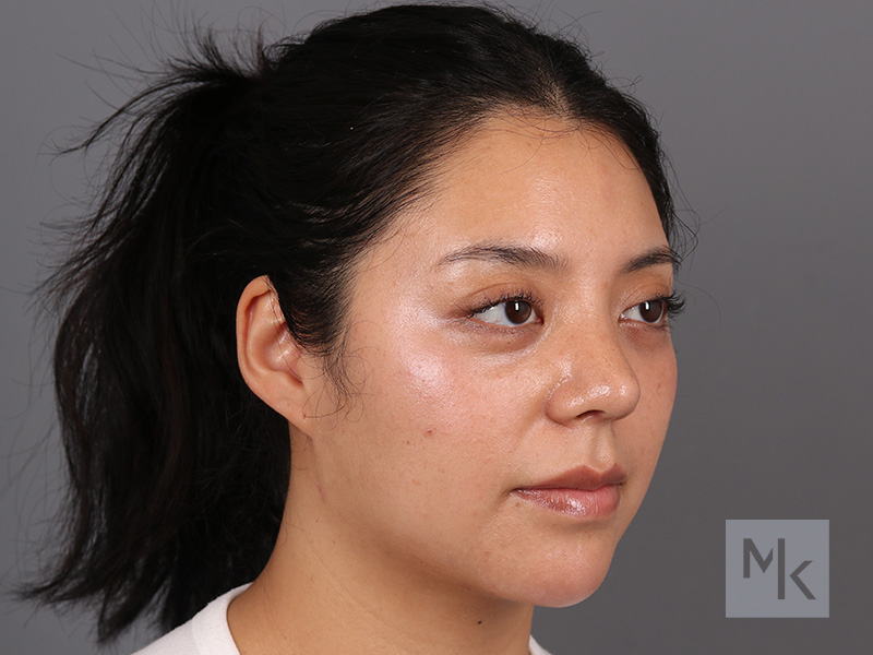 Rhinoplasty Before and After | Dr. Michael Kim