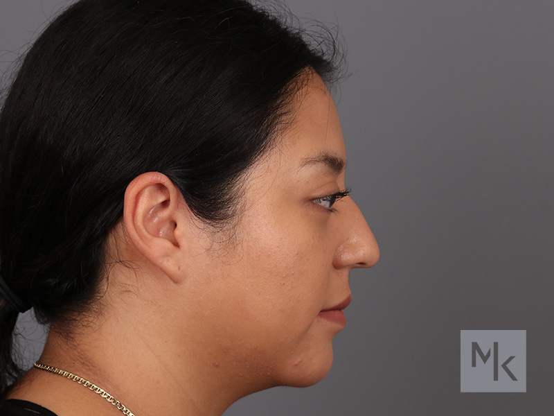 Rhinoplasty Before and After | Dr. Michael Kim