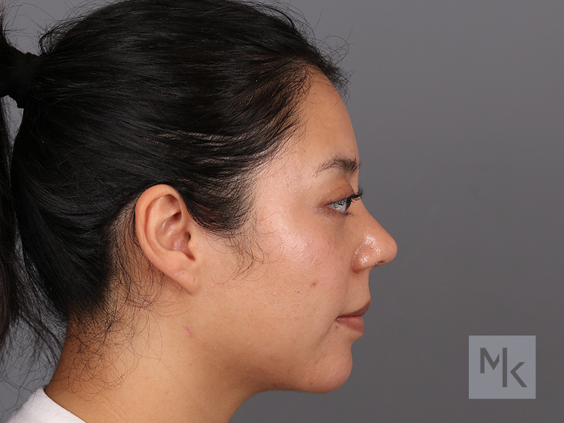 Rhinoplasty Before and After | Dr. Michael Kim