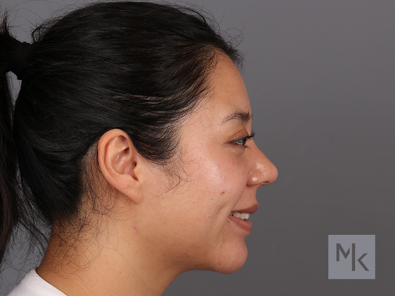 Rhinoplasty Before and After | Dr. Michael Kim