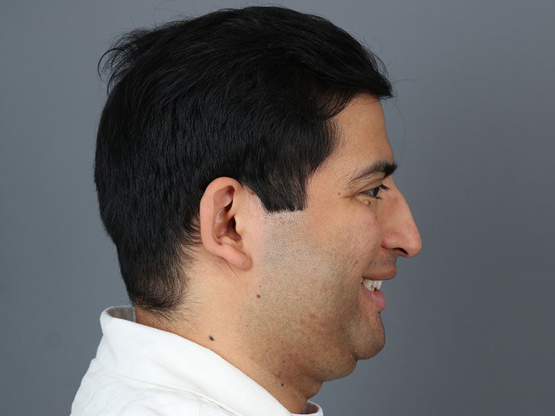 Rhinoplasty Before and After | Dr. Michael Kim