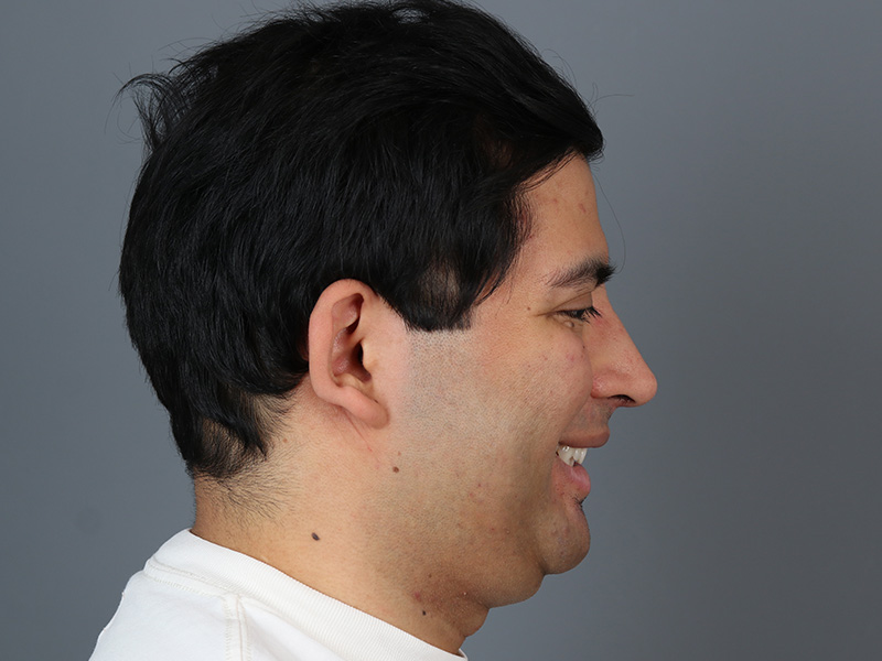 Rhinoplasty Before and After | Dr. Michael Kim
