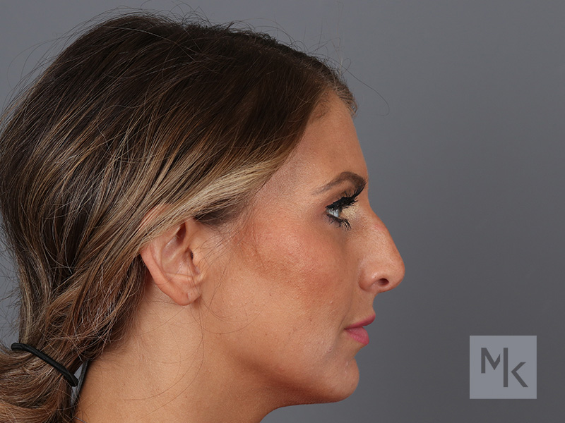 Rhinoplasty Before and After | Dr. Michael Kim