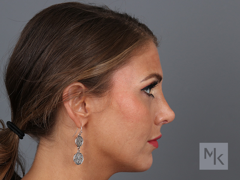 Rhinoplasty Before and After | Dr. Michael Kim