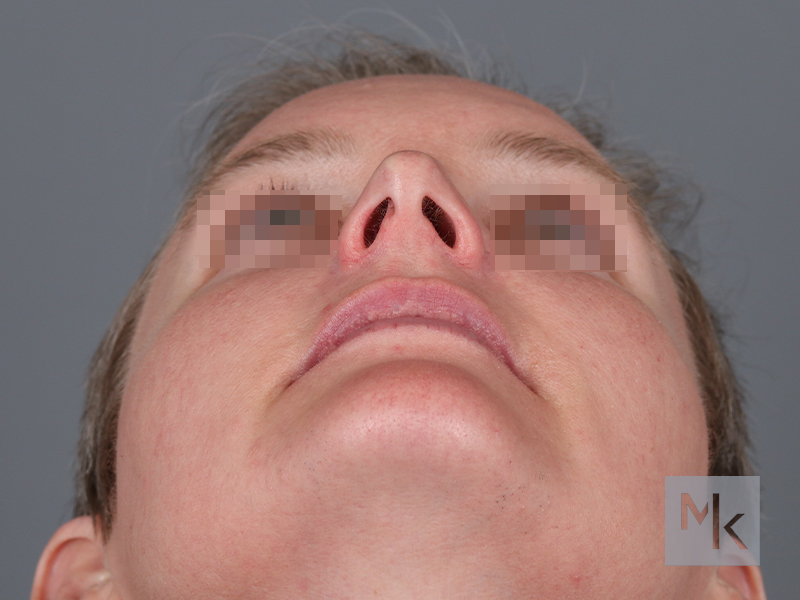 Rhinoplasty Before and After | Dr. Michael Kim