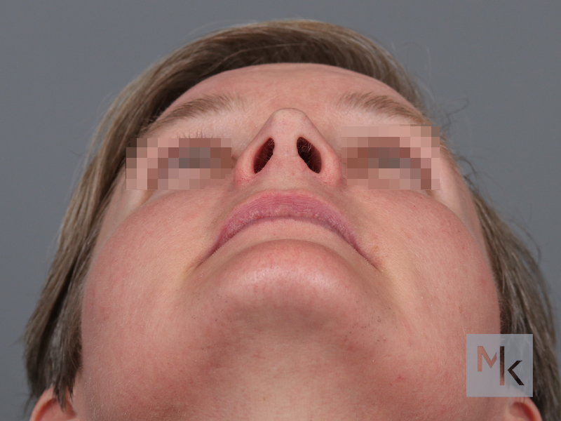 Rhinoplasty Before and After | Dr. Michael Kim