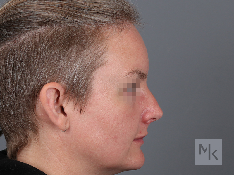 Rhinoplasty Before and After | Dr. Michael Kim