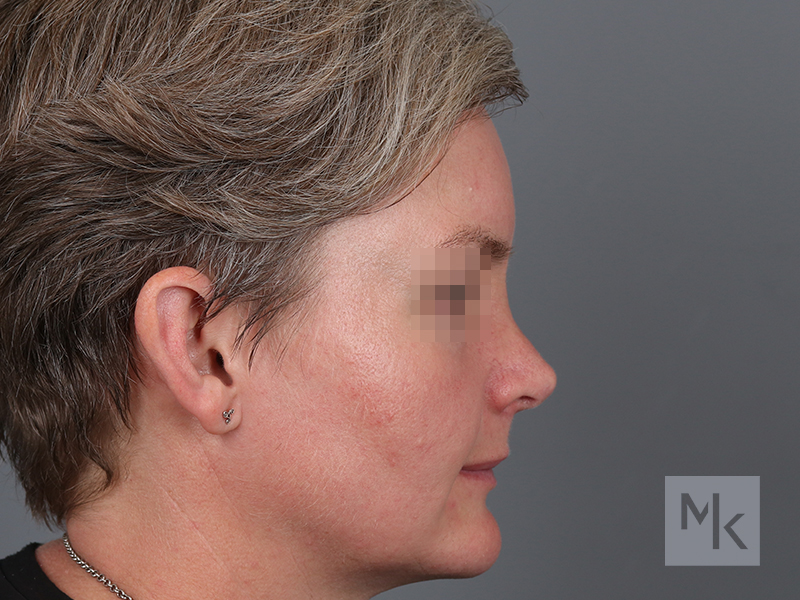 Rhinoplasty Before and After | Dr. Michael Kim