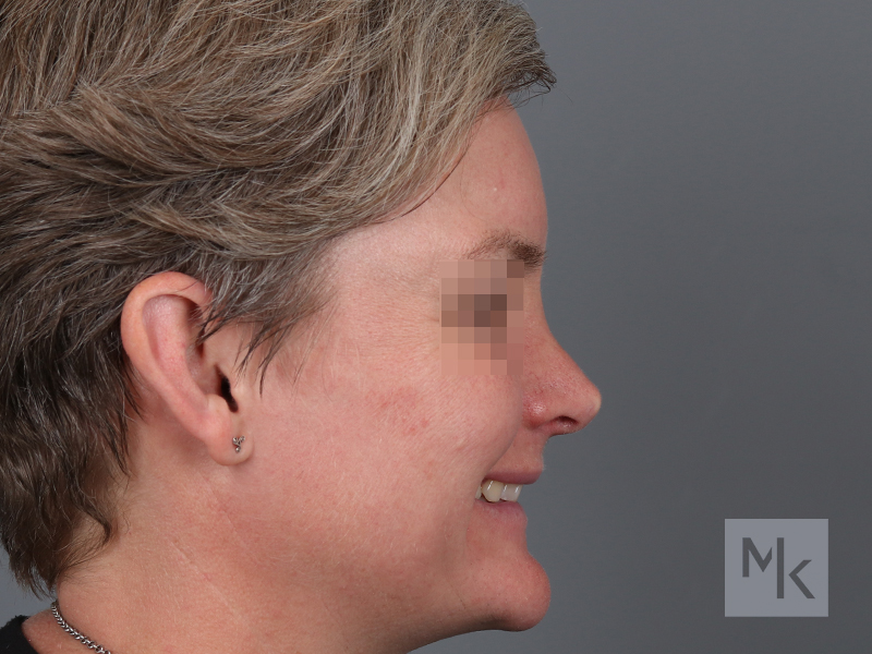 Rhinoplasty Before and After | Dr. Michael Kim