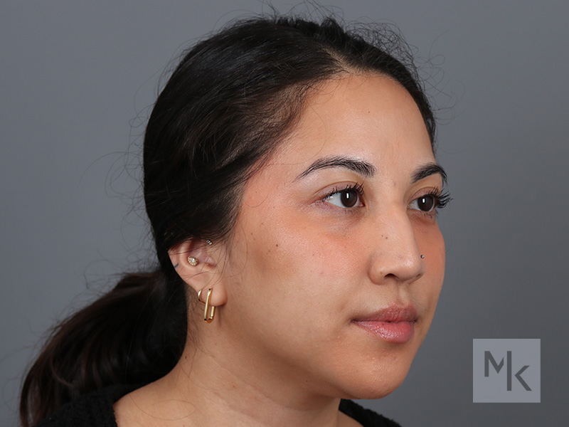 Rhinoplasty Before and After | Dr. Michael Kim