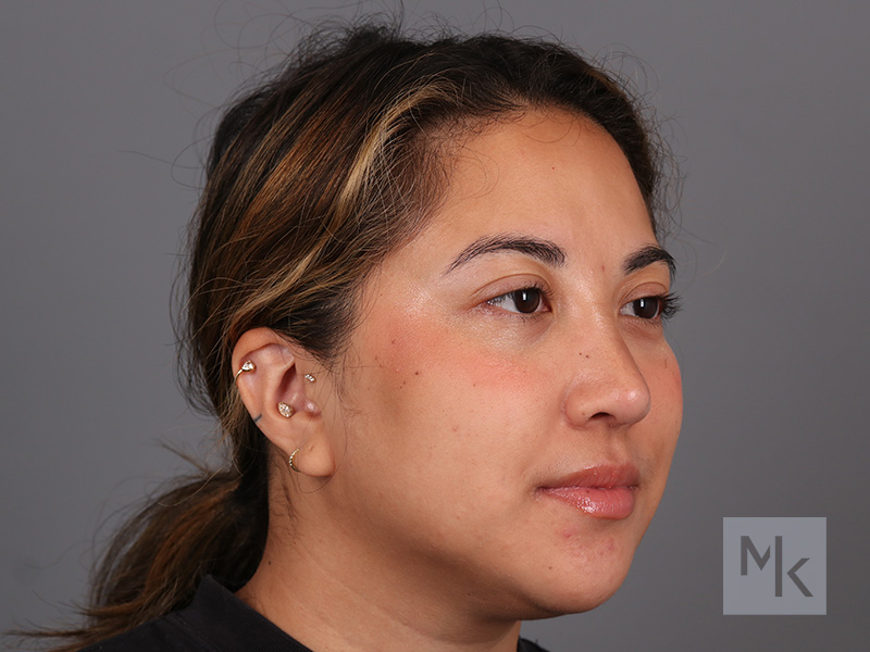 Rhinoplasty Before and After | Dr. Michael Kim