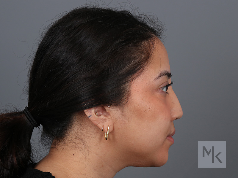 Rhinoplasty Before and After | Dr. Michael Kim