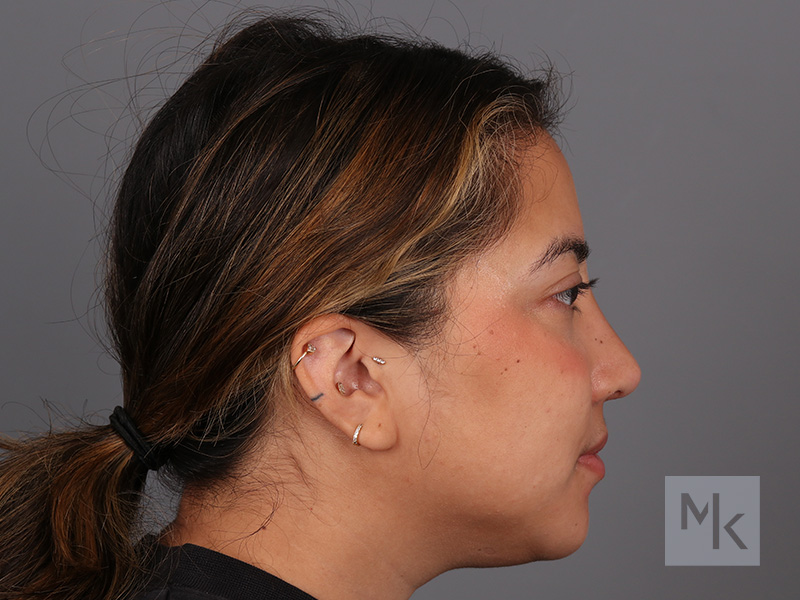 Rhinoplasty Before and After | Dr. Michael Kim