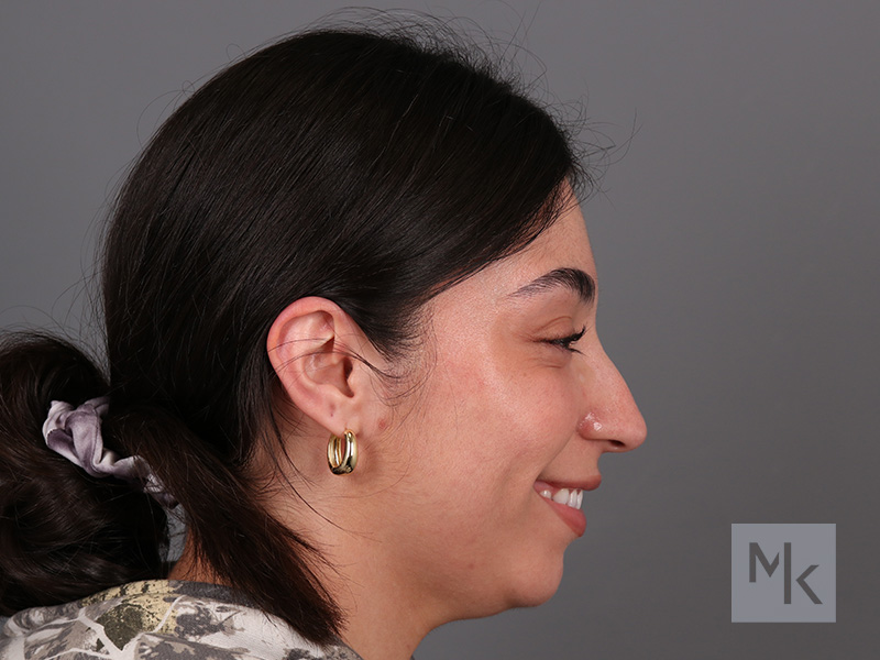 Rhinoplasty Before and After | Dr. Michael Kim