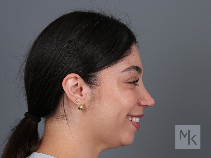 Rhinoplasty Before and After | Dr. Michael Kim