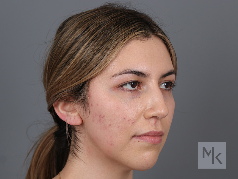 Rhinoplasty Before and After | Dr. Michael Kim