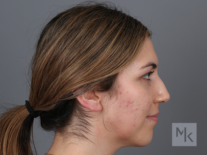 Rhinoplasty Before and After | Dr. Michael Kim