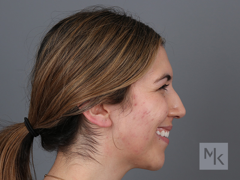 Rhinoplasty Before and After | Dr. Michael Kim