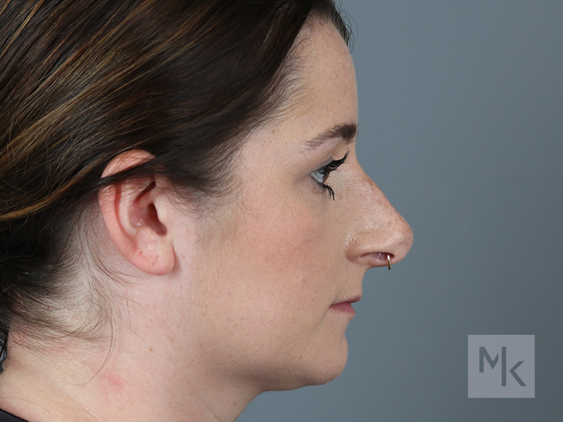 Rhinoplasty Before and After | Dr. Michael Kim