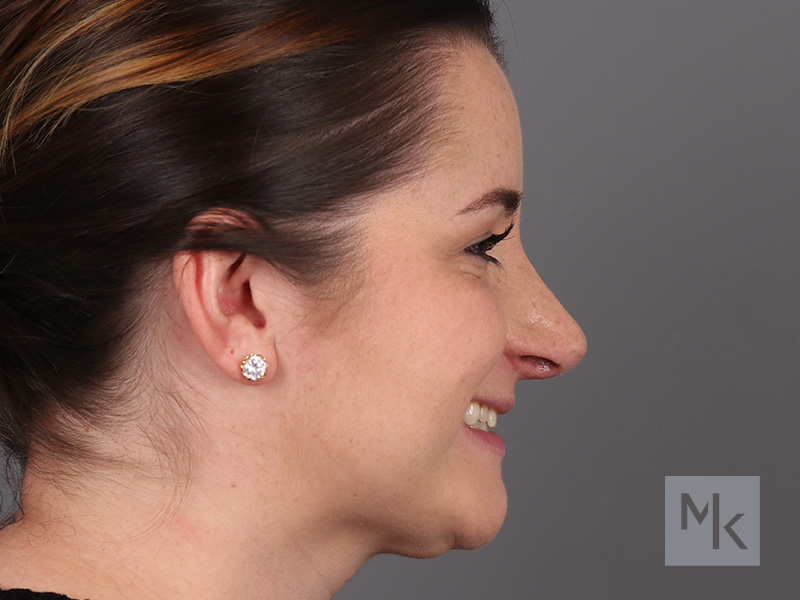 Rhinoplasty Before and After | Dr. Michael Kim