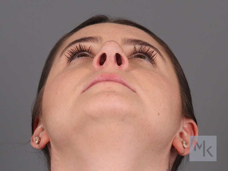 Rhinoplasty Before and After | Dr. Michael Kim