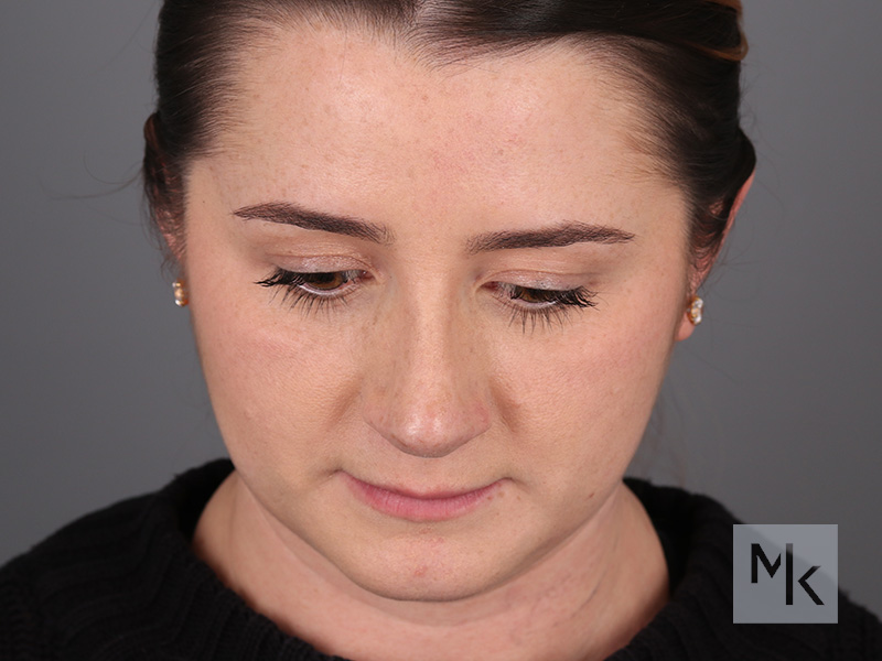 Rhinoplasty Before and After | Dr. Michael Kim