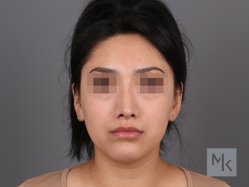 Rhinoplasty Before and After | Dr. Michael Kim