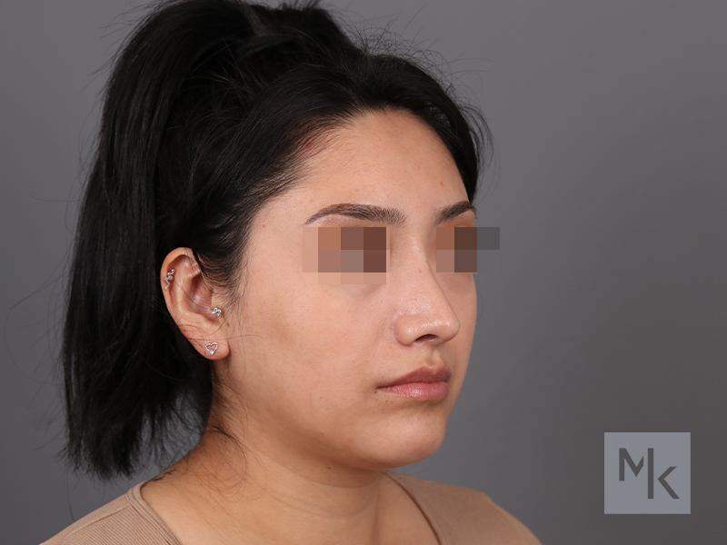 Rhinoplasty Before and After | Dr. Michael Kim