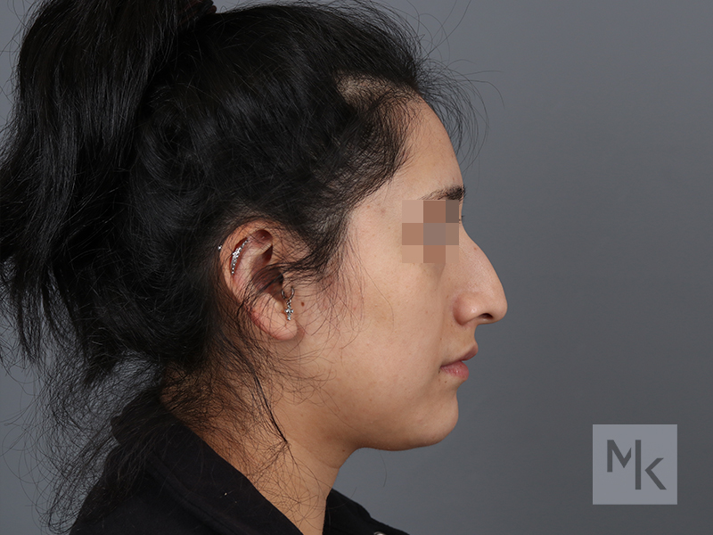 Rhinoplasty Before and After | Dr. Michael Kim