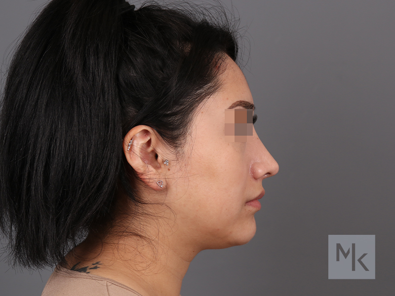 Rhinoplasty Before and After | Dr. Michael Kim