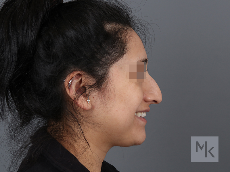 Rhinoplasty Before and After | Dr. Michael Kim