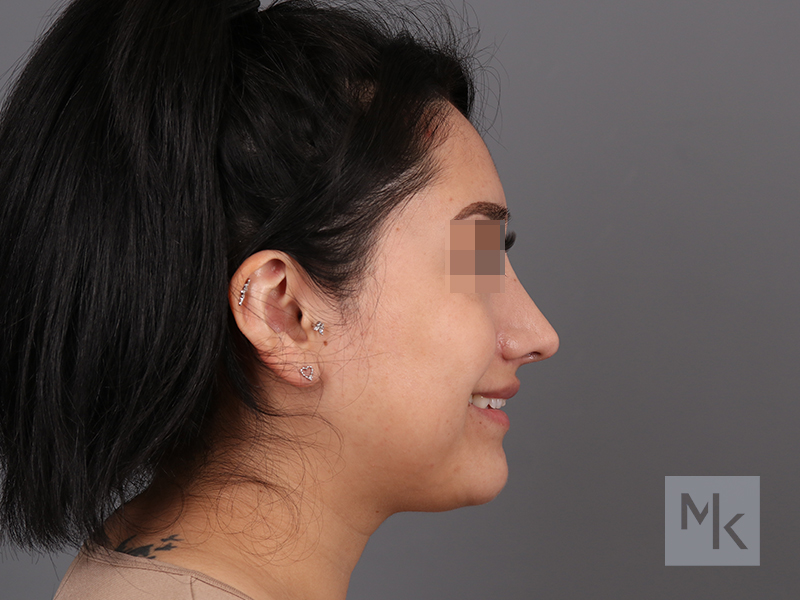 Rhinoplasty Before and After | Dr. Michael Kim