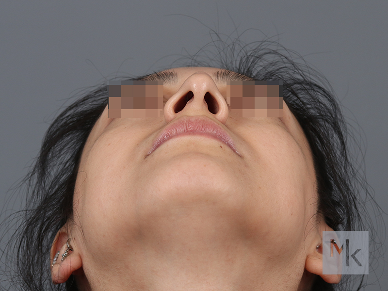 Rhinoplasty Before and After | Dr. Michael Kim