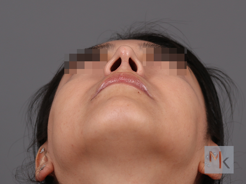 Rhinoplasty Before and After | Dr. Michael Kim