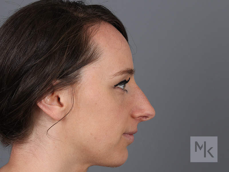 Rhinoplasty Before and After | Dr. Michael Kim