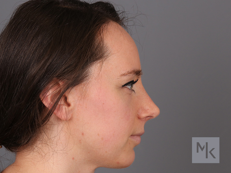 Rhinoplasty Before and After | Dr. Michael Kim